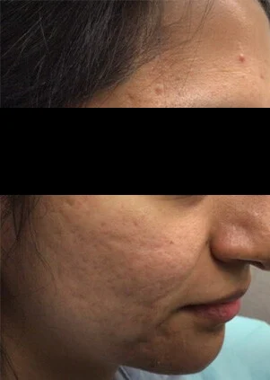 Antes del tratamiento