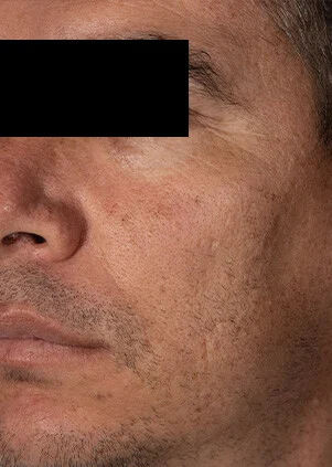 Antes del tratamiento