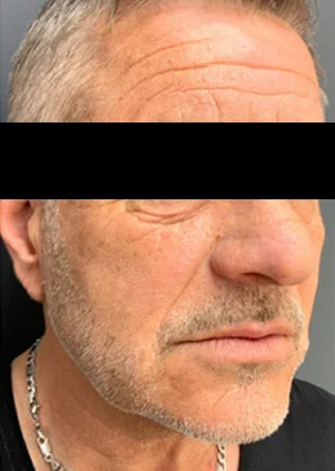 Antes del tratamiento