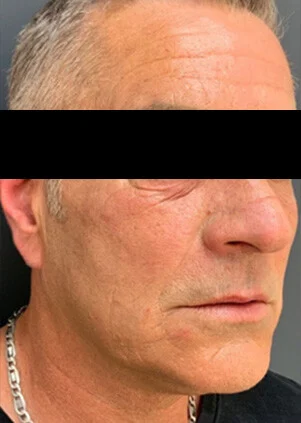 Después del tratamiento