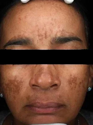 Antes del tratamiento