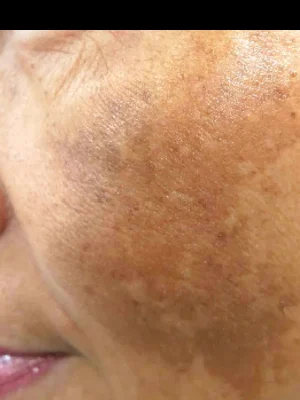 Antes del tratamiento