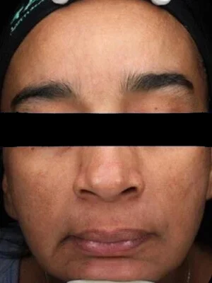 Después del tratamiento