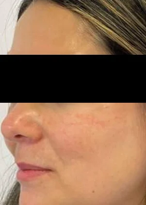 Después del tratamiento