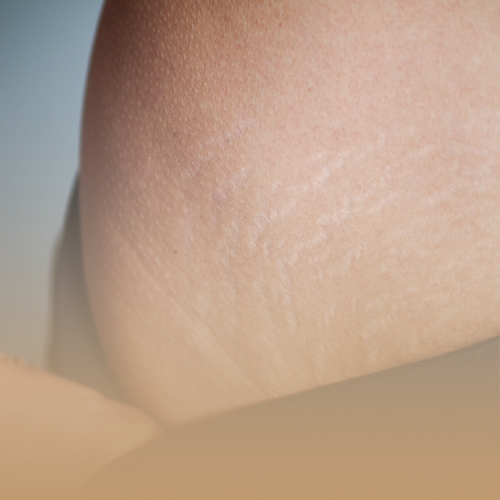 Tratamiento Estrías