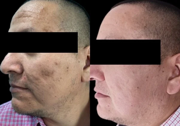 Después de 2 sesiones