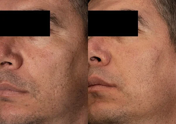 Líneas de expresión