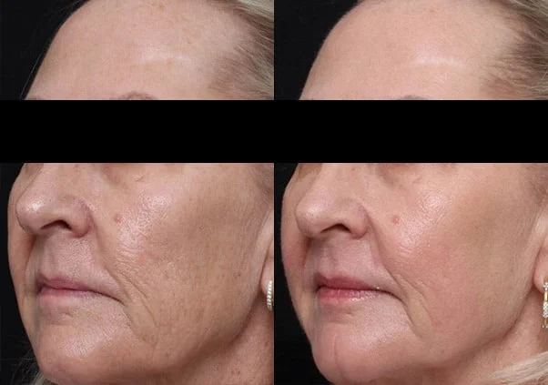 Reducción de arrugas